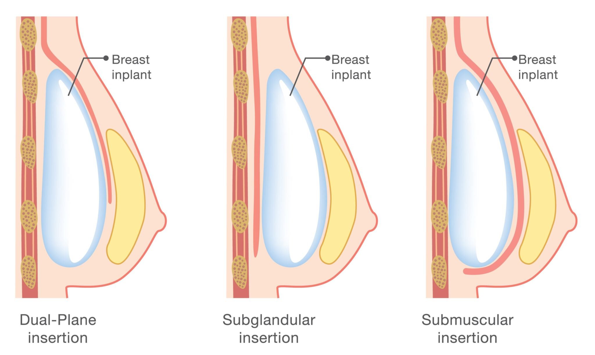 Breast silicone implant infographic