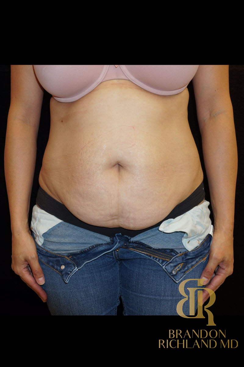 Abdominoplasty Before & After Image