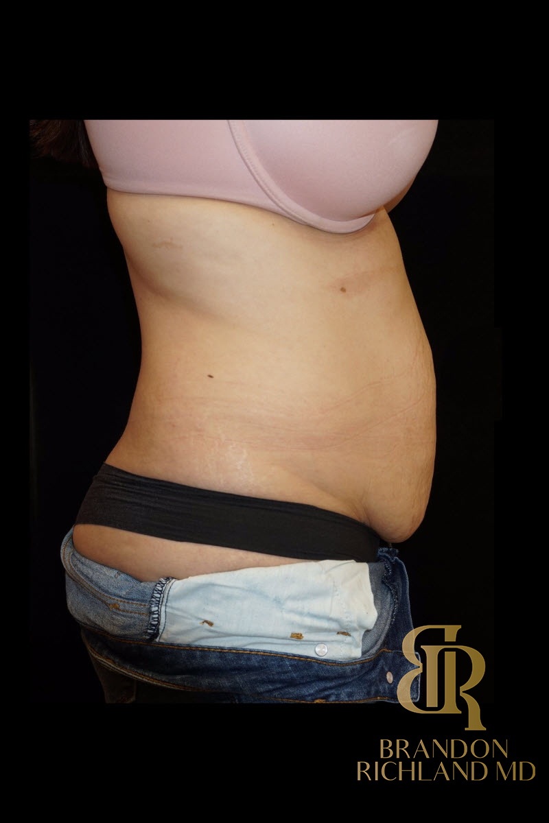 Abdominoplasty Before & After Image