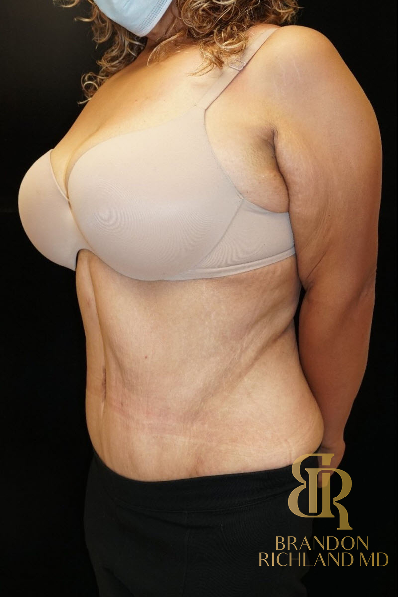 Abdominoplasty Before & After Image