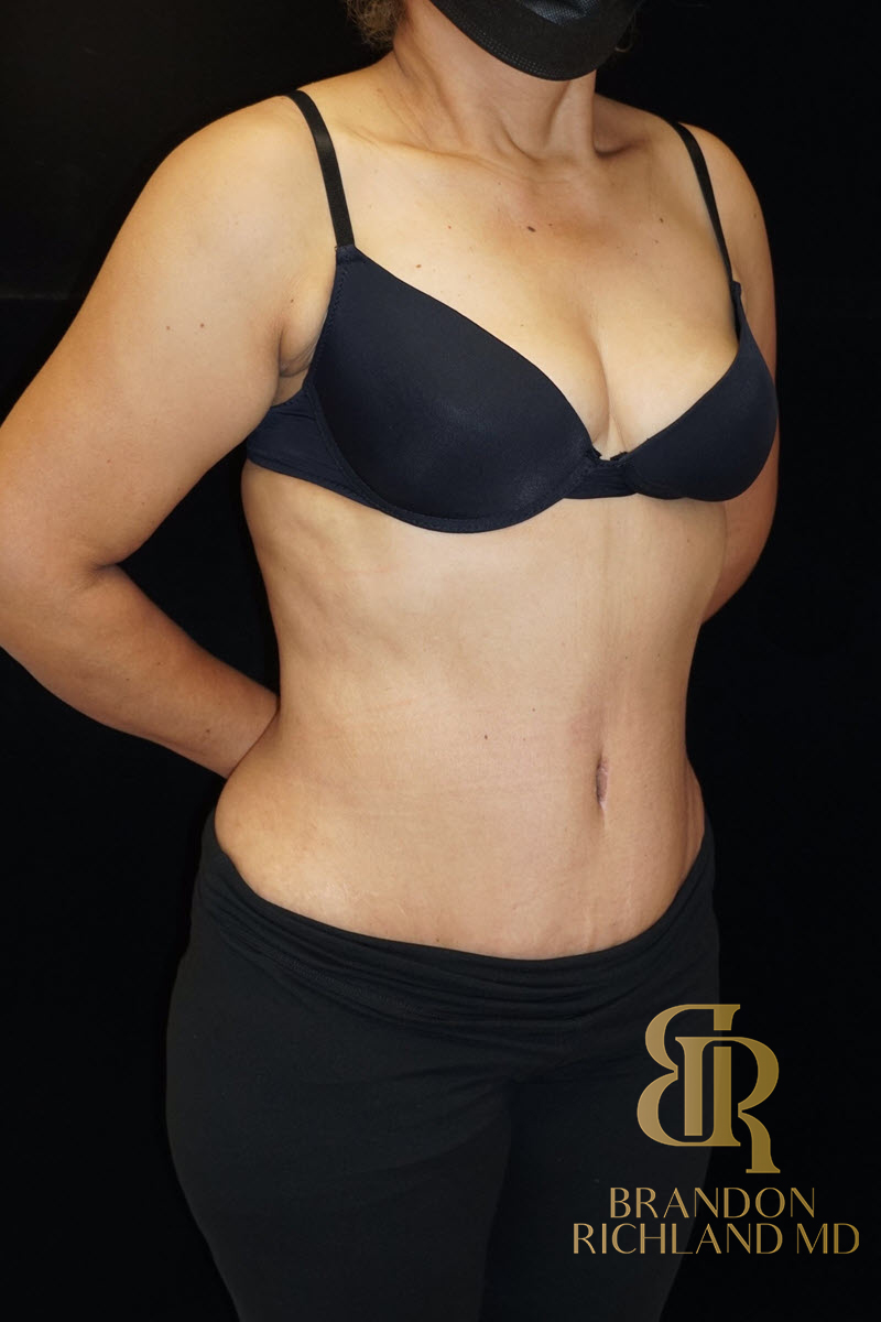 Abdominoplasty Before & After Image