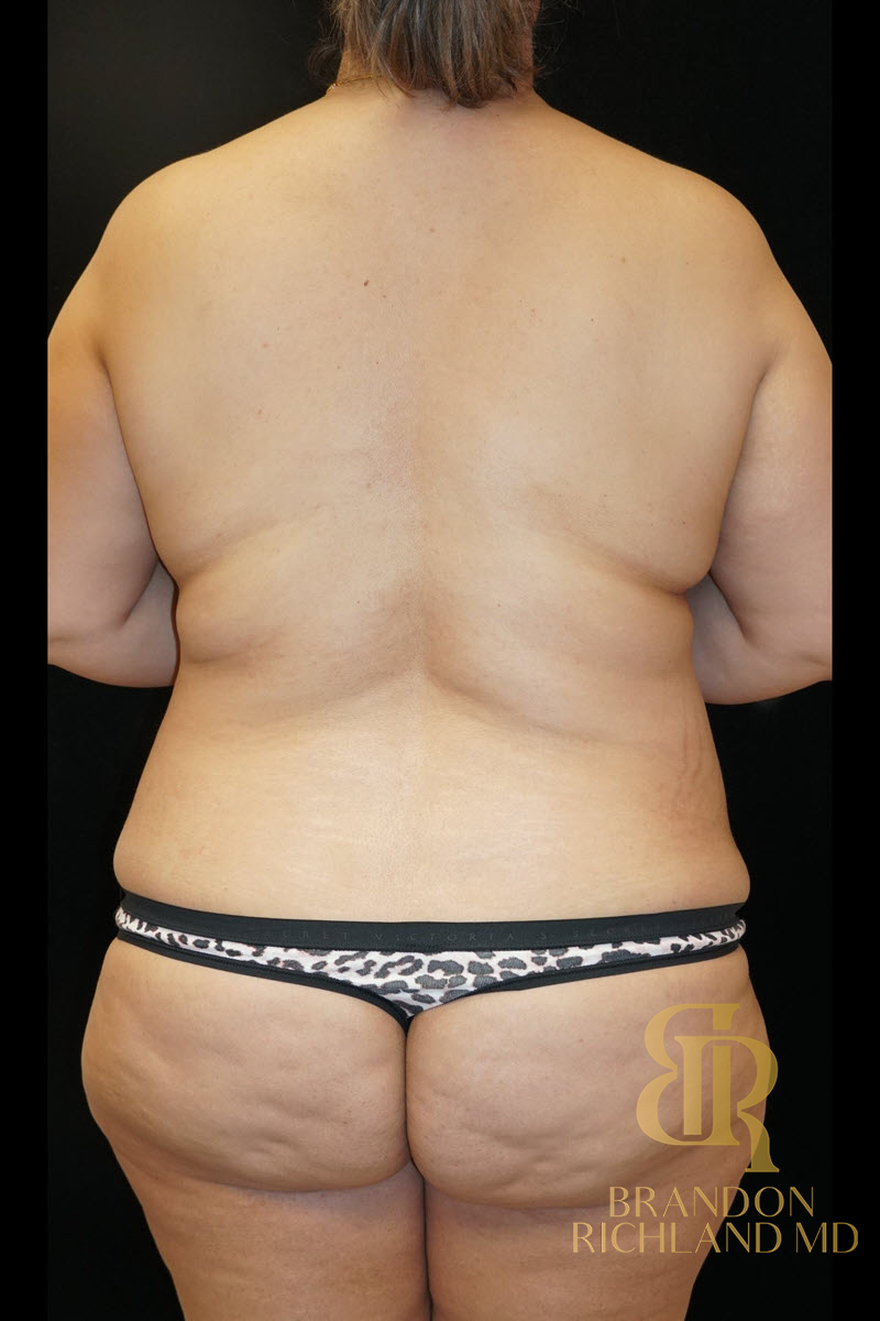 Abdominoplasty Before & After Image