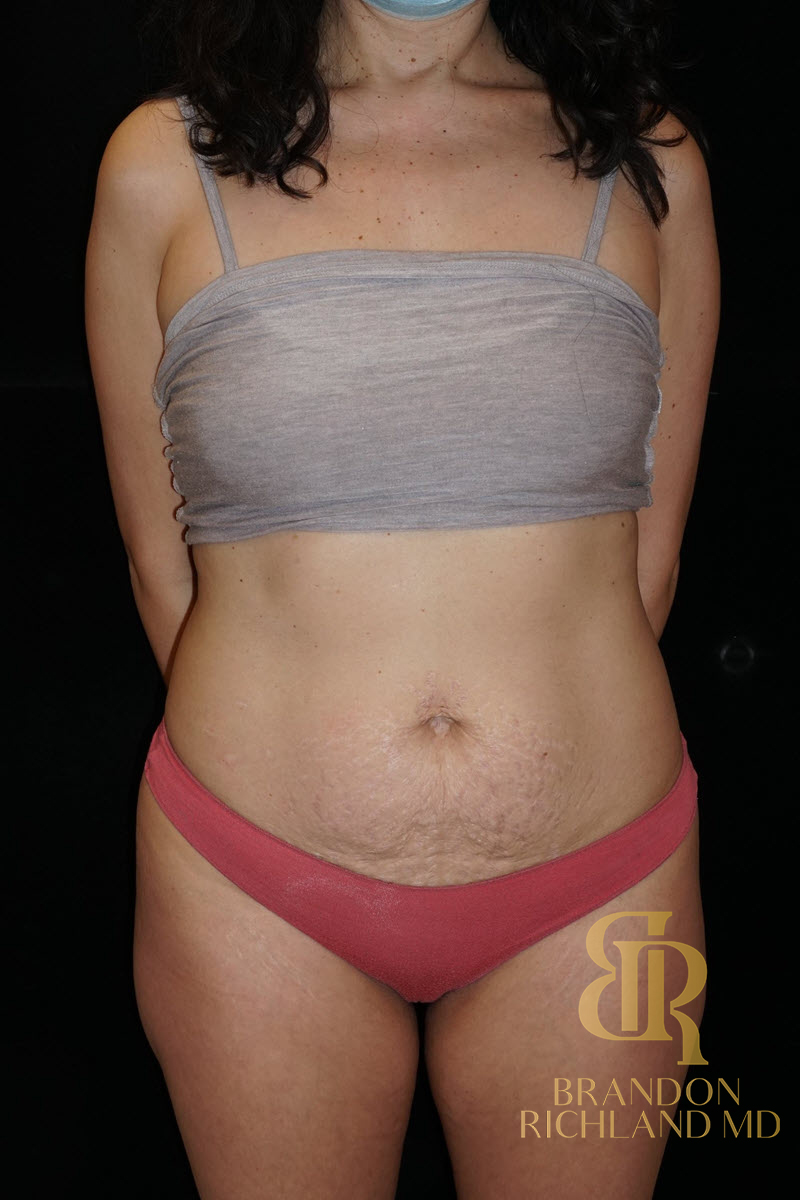 Abdominoplasty Before & After Image