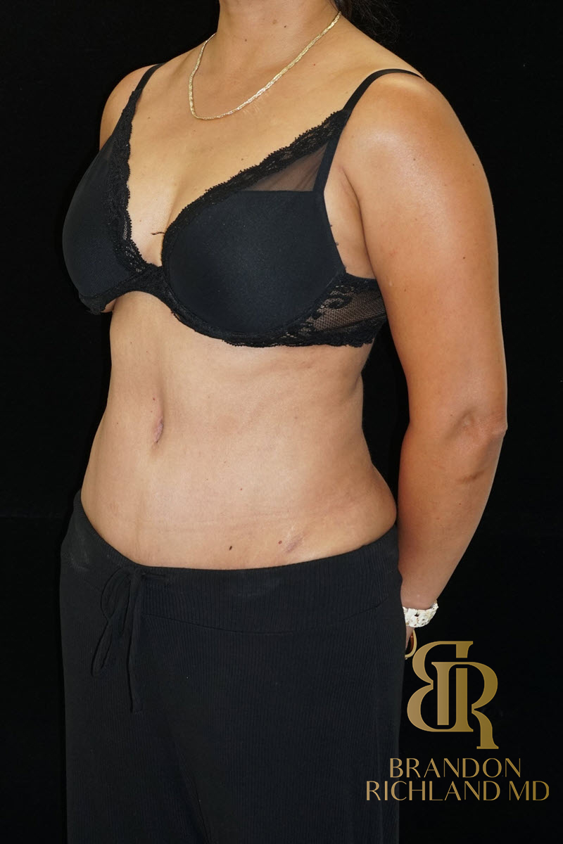 Abdominoplasty Before & After Image