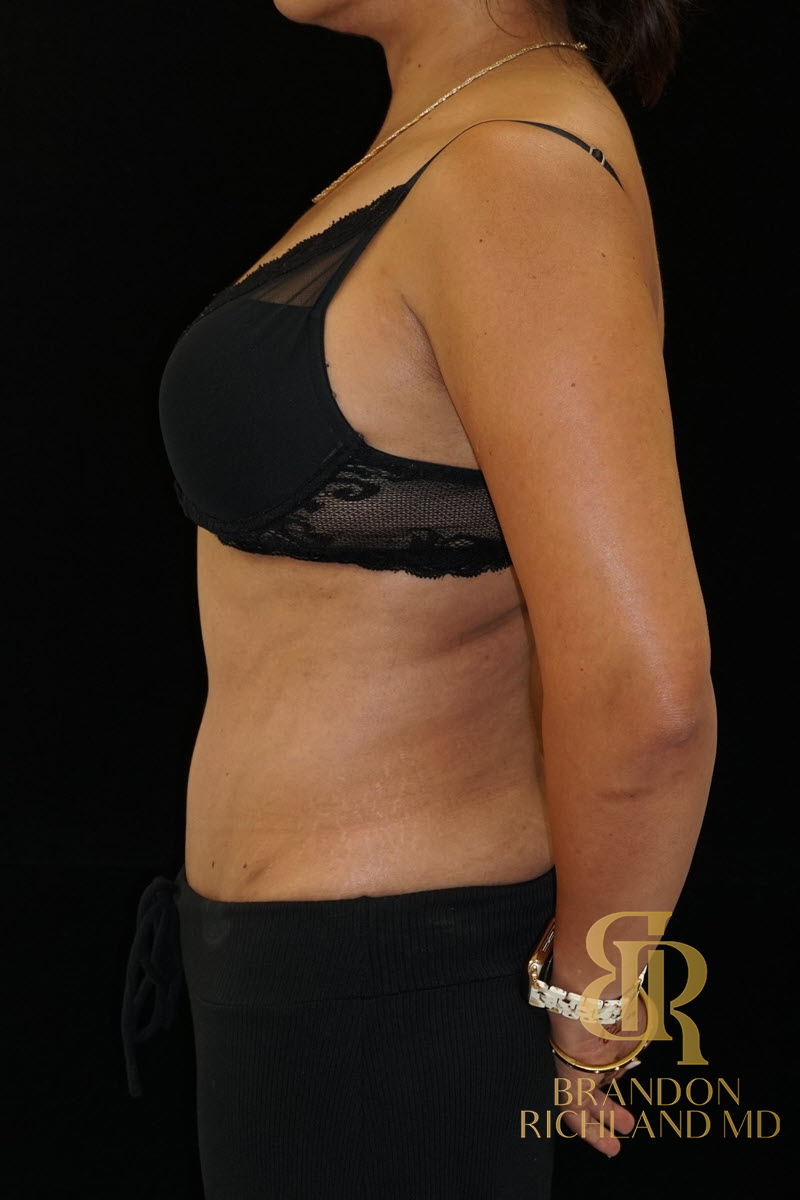 Abdominoplasty Before & After Image