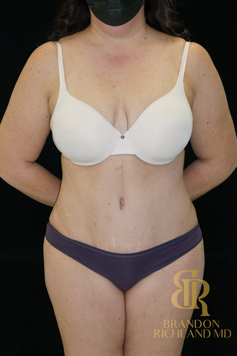 Abdominoplasty Before & After Image