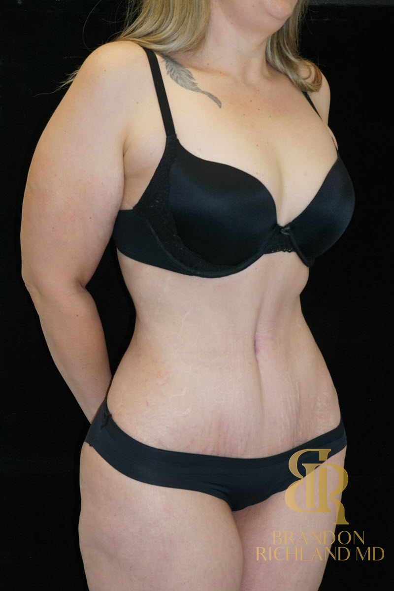 Abdominoplasty Before & After Image