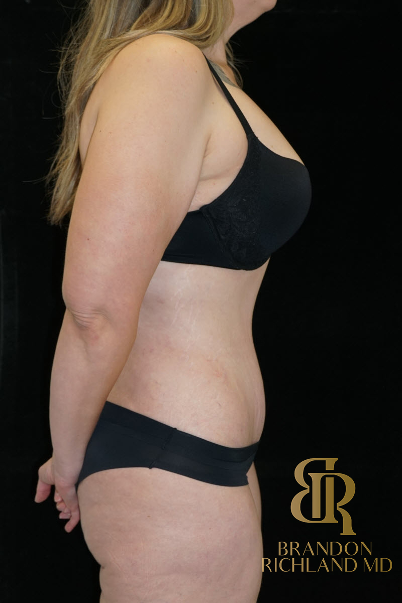 Abdominoplasty Before & After Image