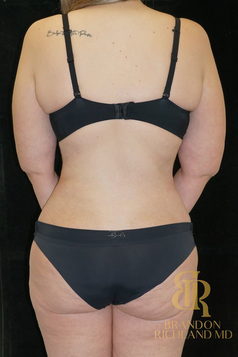 Abdominoplasty Before & After Image