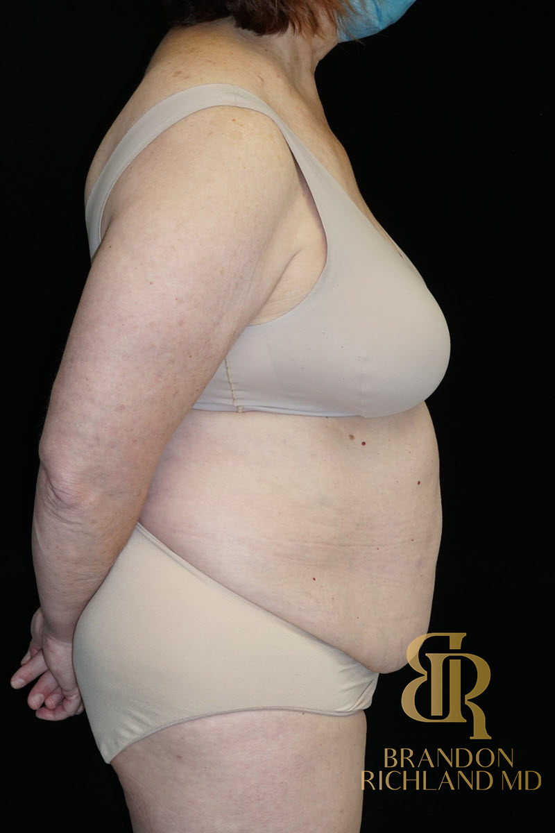 Abdominoplasty Before & After Image