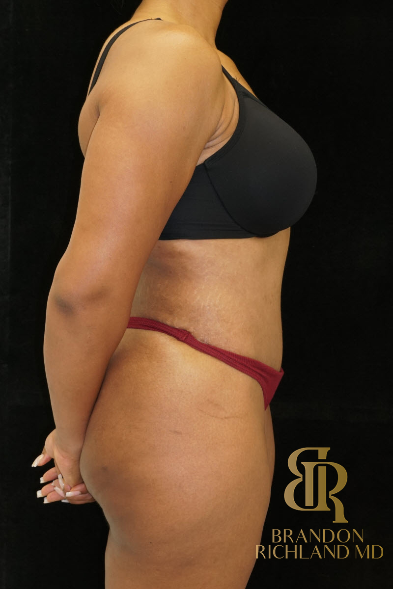 Abdominoplasty Before & After Image