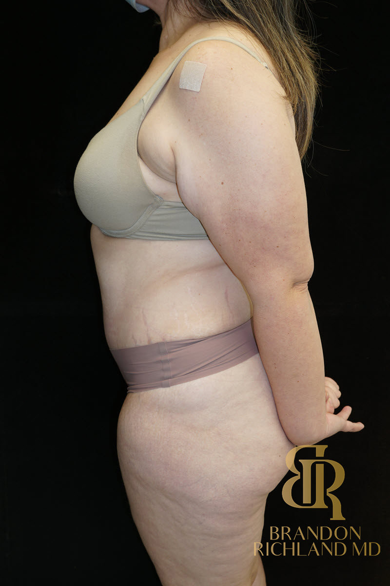 Abdominoplasty Before & After Image
