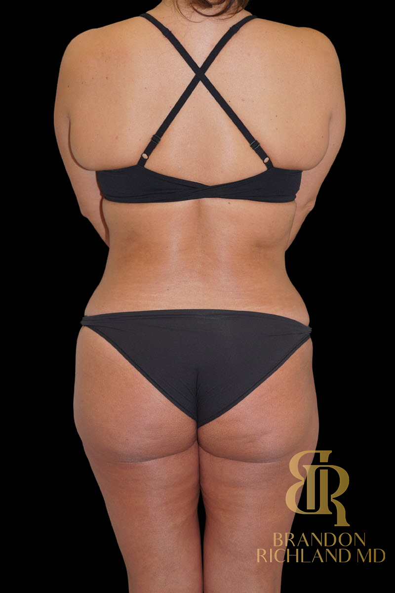 Abdominoplasty Before & After Image