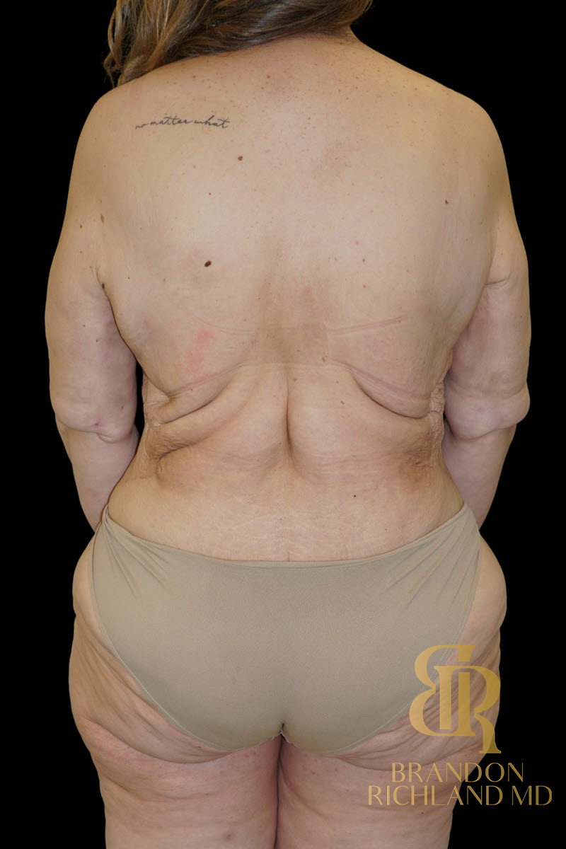 Abdominoplasty Before & After Image