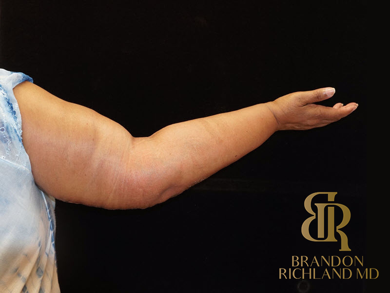 Brachioplasty Before & After Image