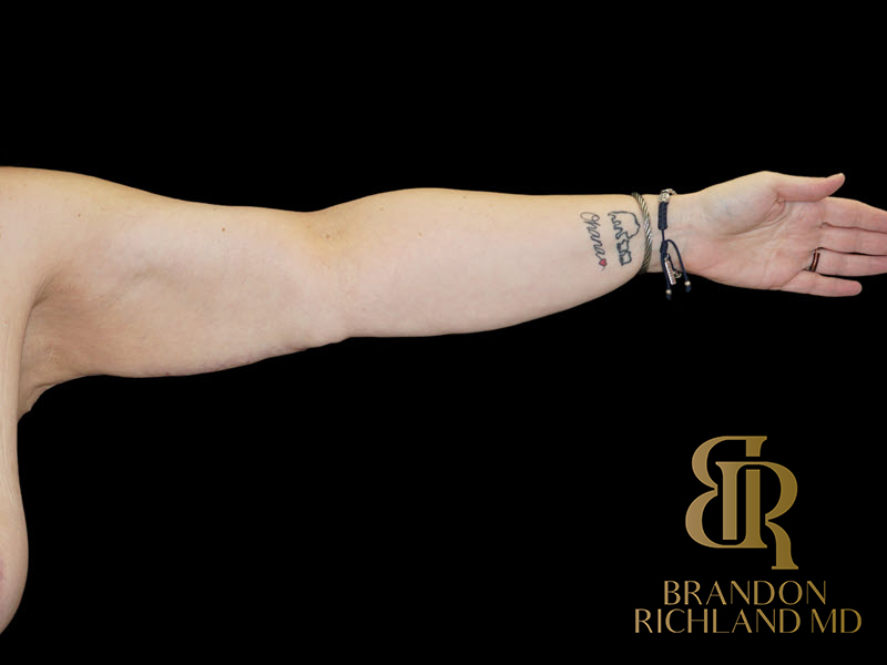 Brachioplasty Before & After Image