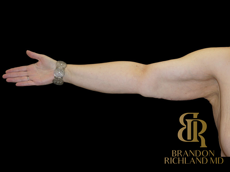 Brachioplasty Before & After Image