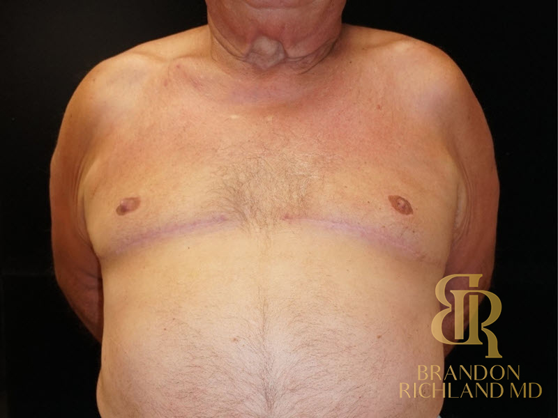 Liposuction Before & After Image