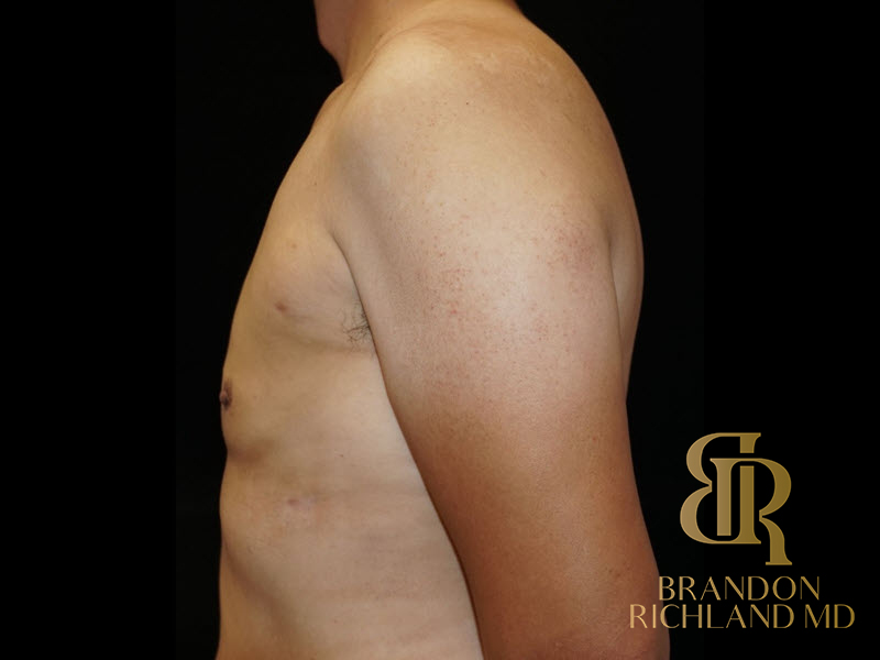 Liposuction Before & After Image