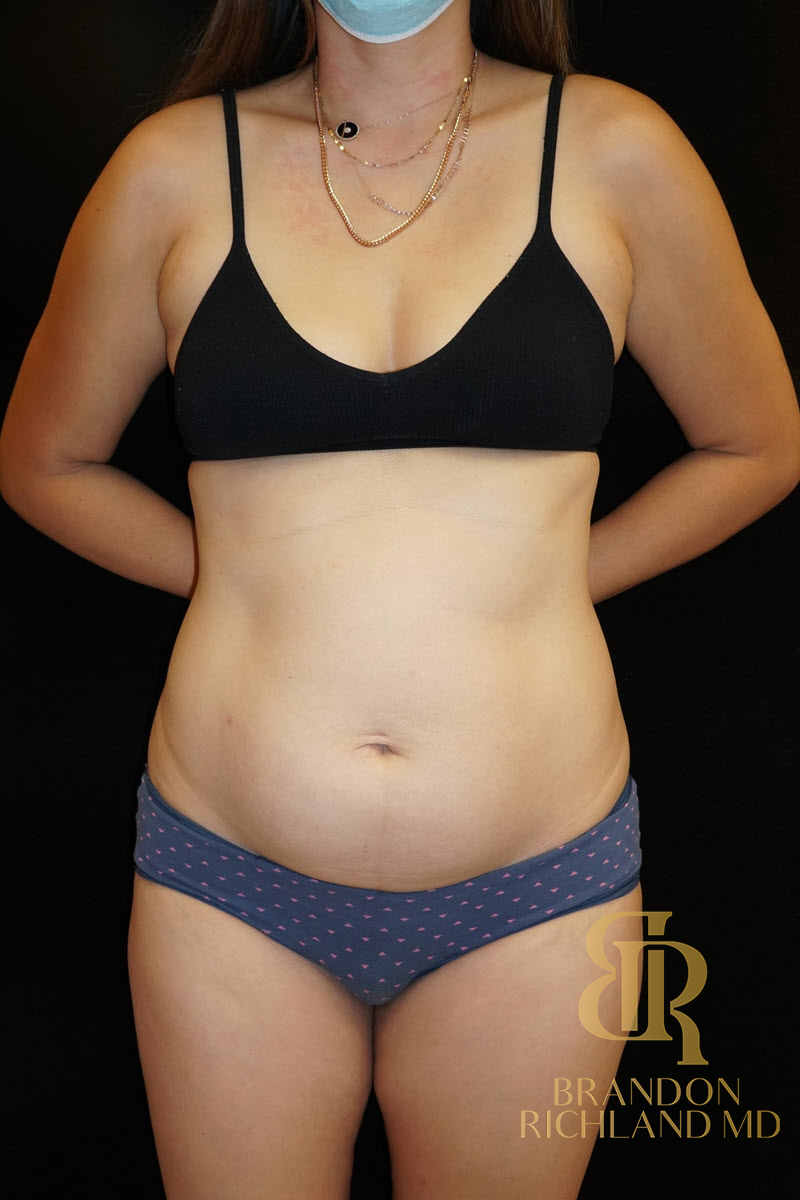 Liposuction Before & After Image