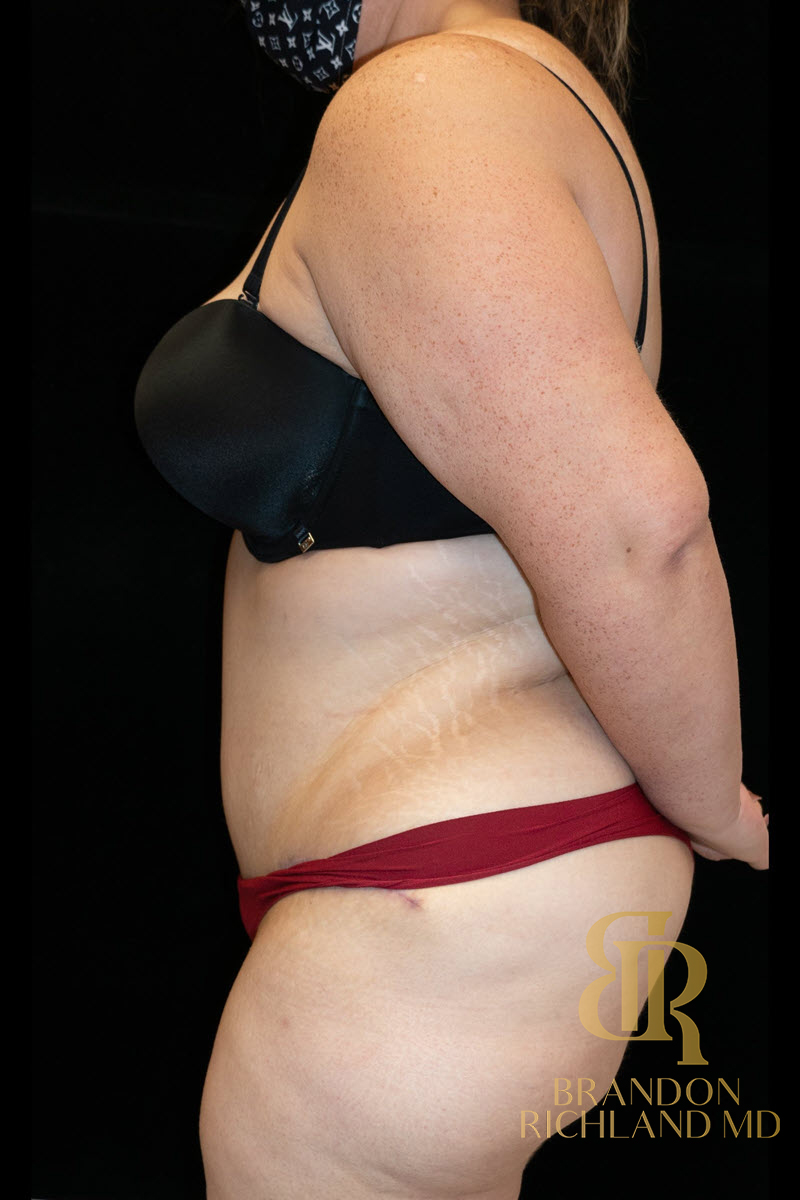 Liposuction Before & After Image