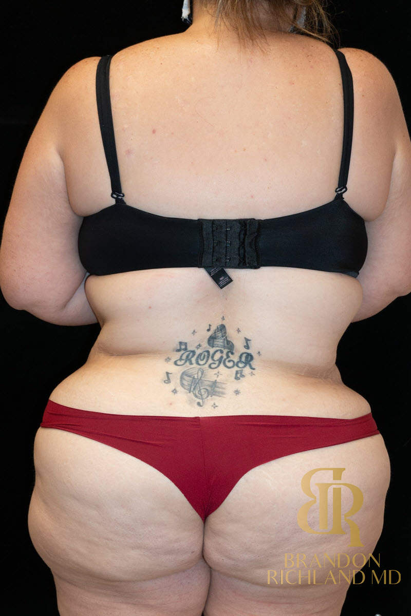 Liposuction Before & After Image