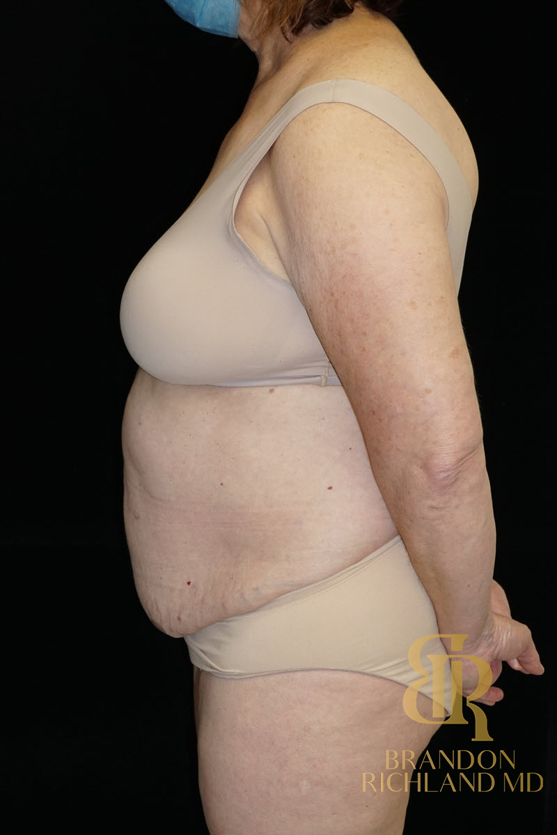 Liposuction Before & After Image