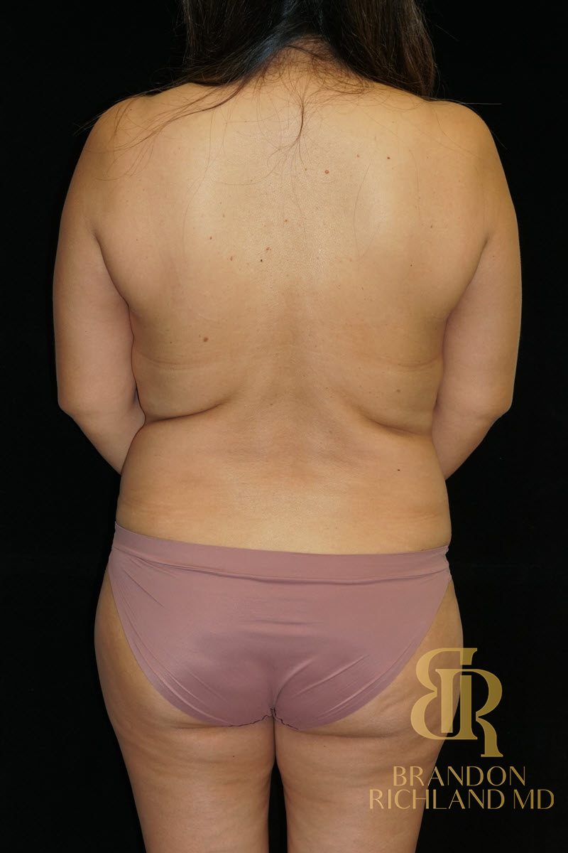 Liposuction Before & After Image