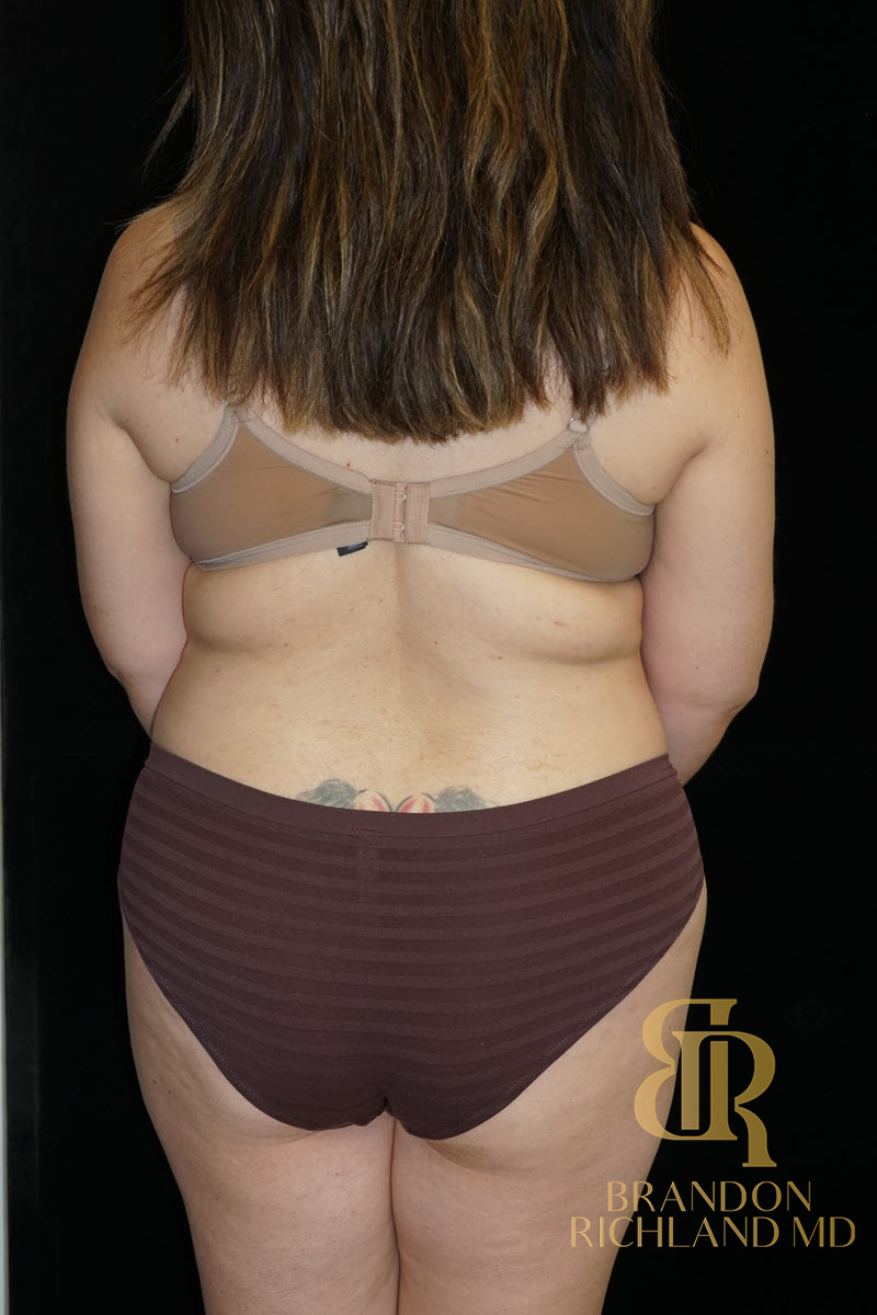 Liposuction Before & After Image