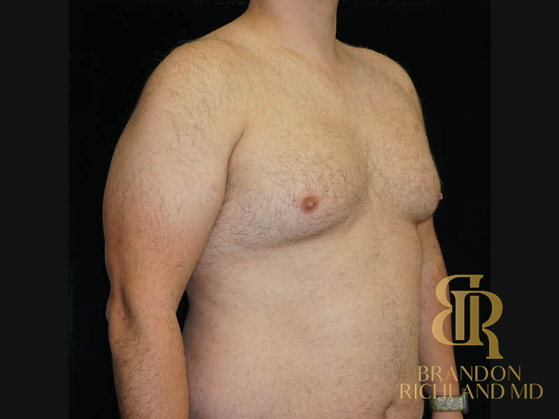 Liposuction Before & After Image