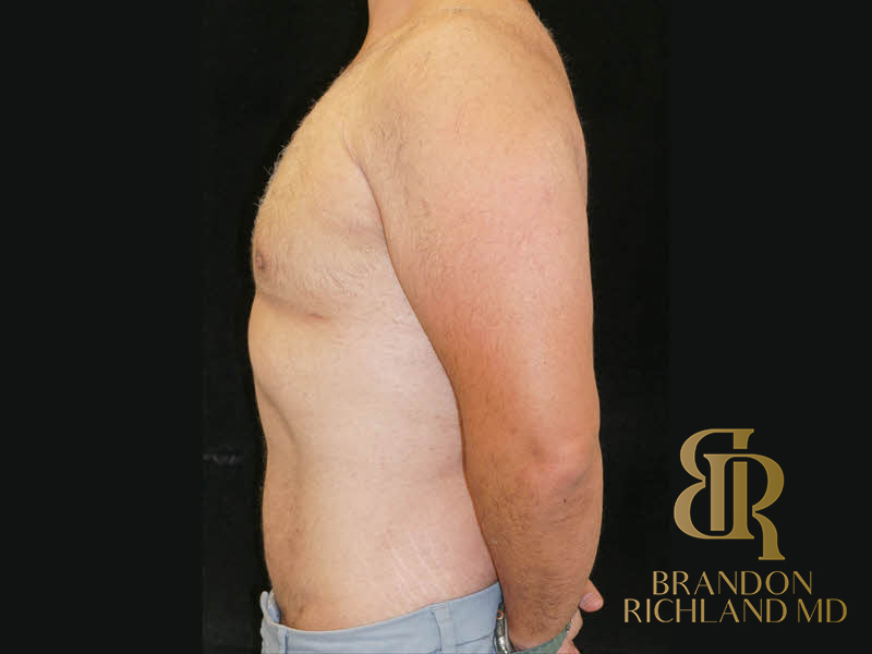 Liposuction Before & After Image