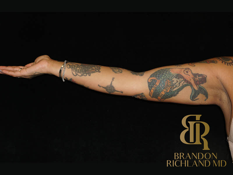 Liposuction Before & After Image