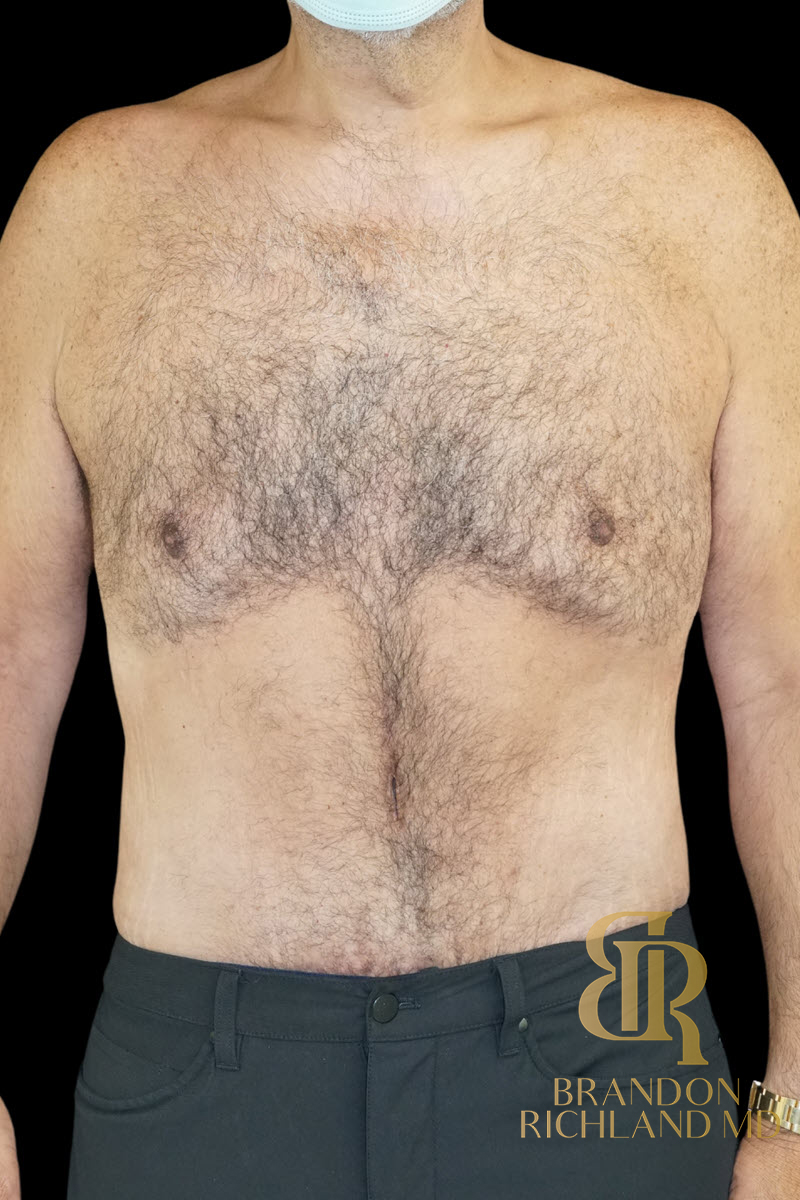Liposuction Before & After Image