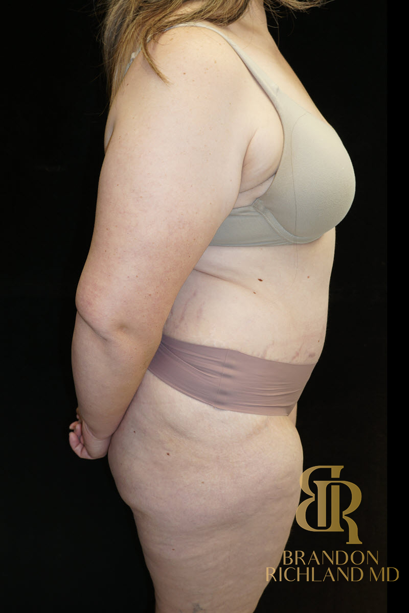 Liposuction Before & After Image