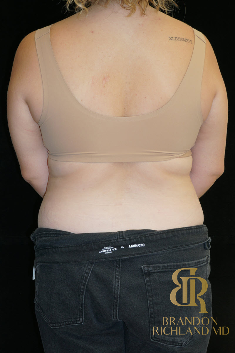 Liposuction Before & After Image