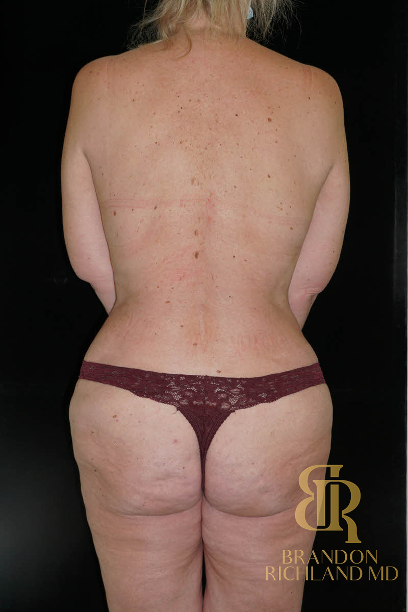 Mommy Makeover Before & After Image