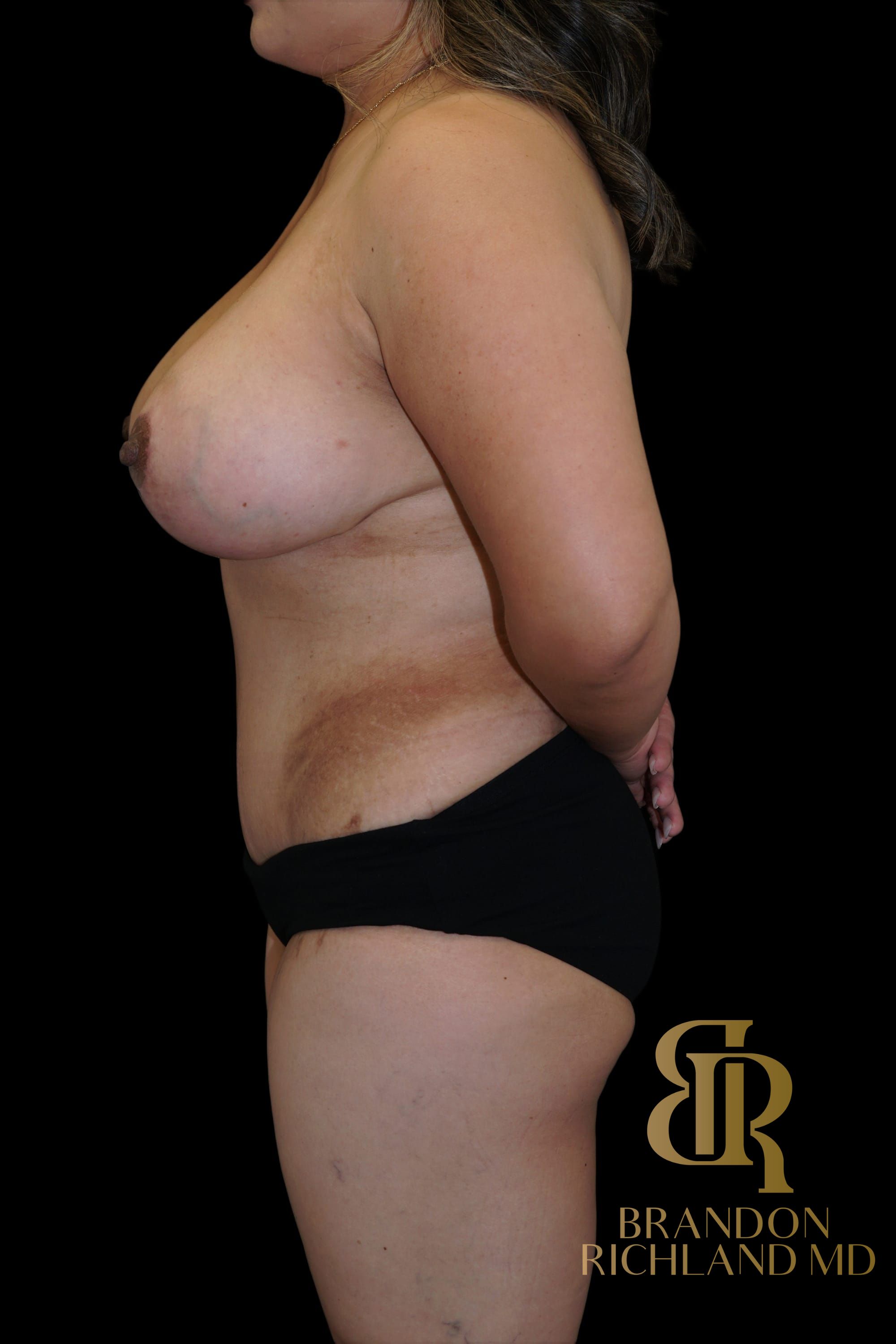 Mommy Makeover Before & After Image