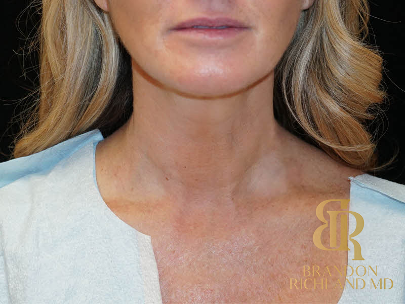 Renuvion Skin Tightening Before & After Image