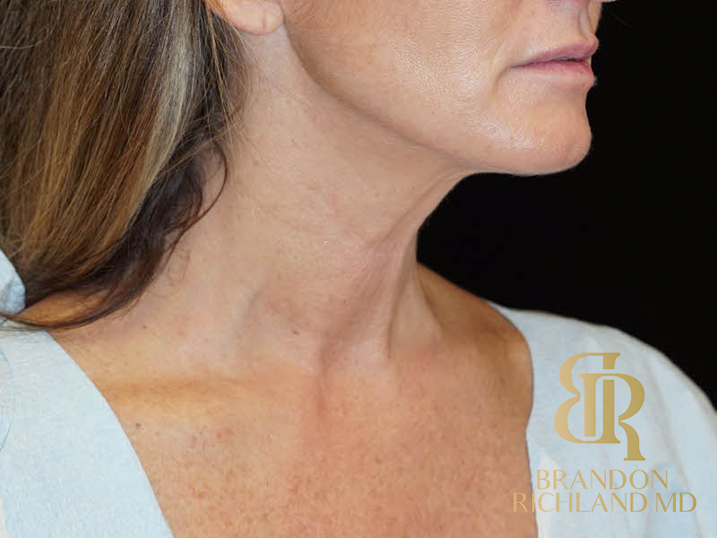 Renuvion Skin Tightening Before & After Image