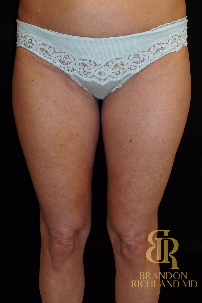 Renuvion Skin Tightening Before & After Image