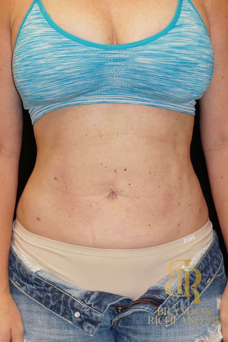 Renuvion Skin Tightening Before & After Image