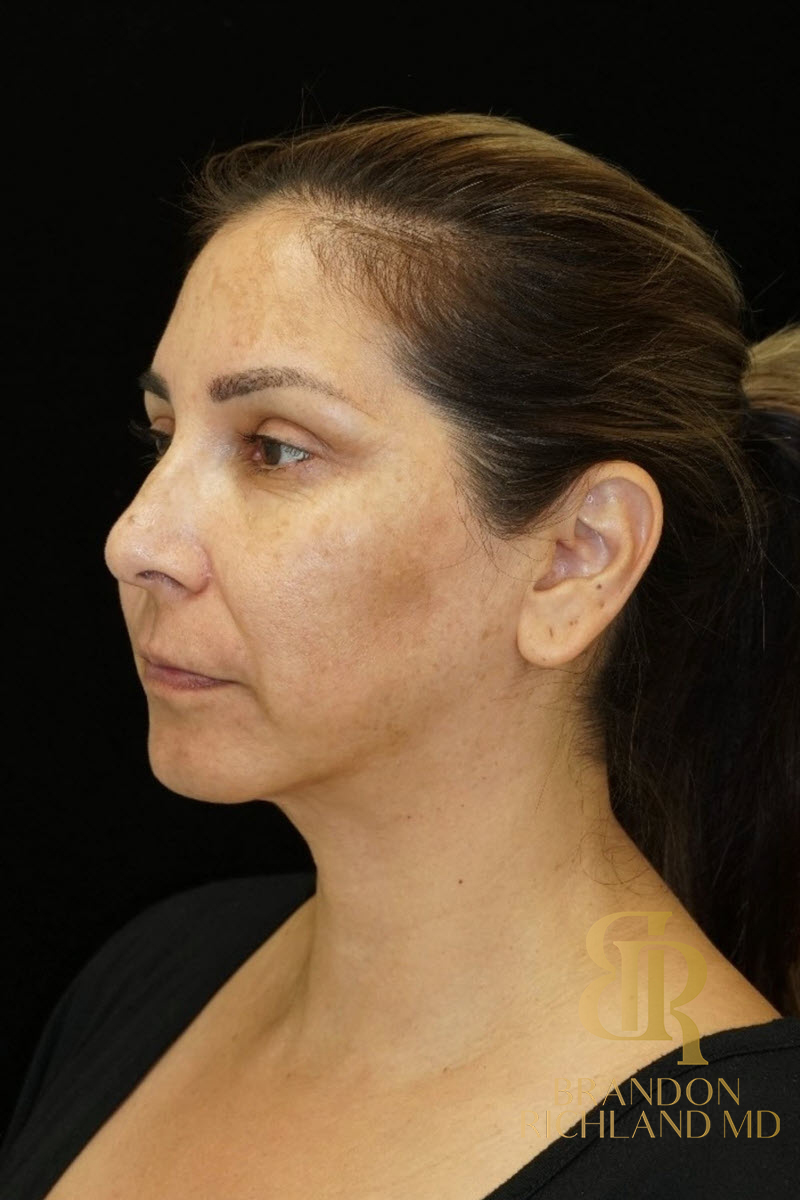 Renuvion Skin Tightening Before & After Image