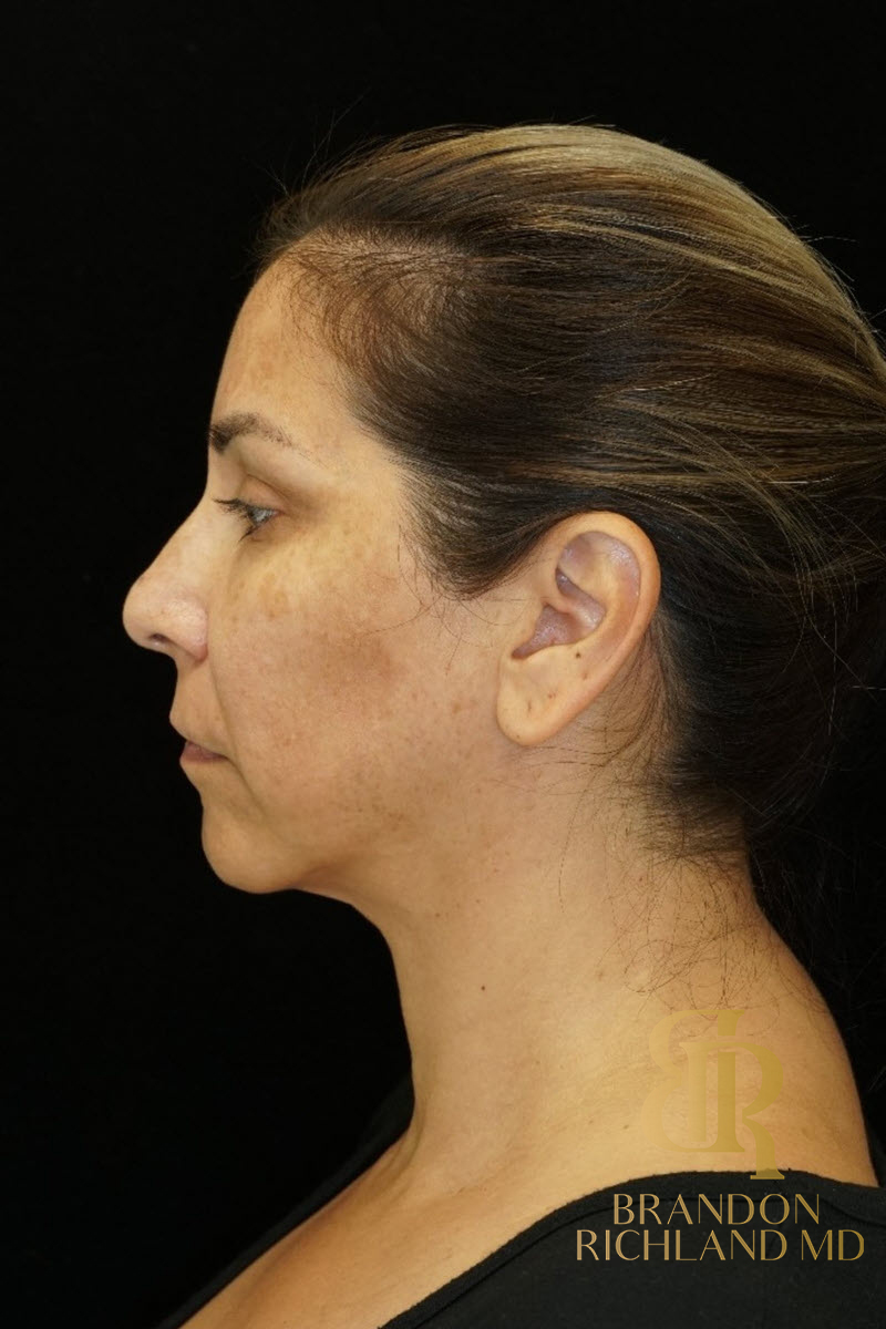 Renuvion Skin Tightening Before & After Image