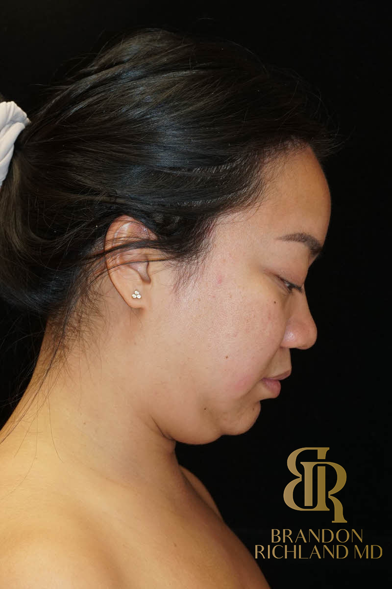 Renuvion Skin Tightening Before & After Image