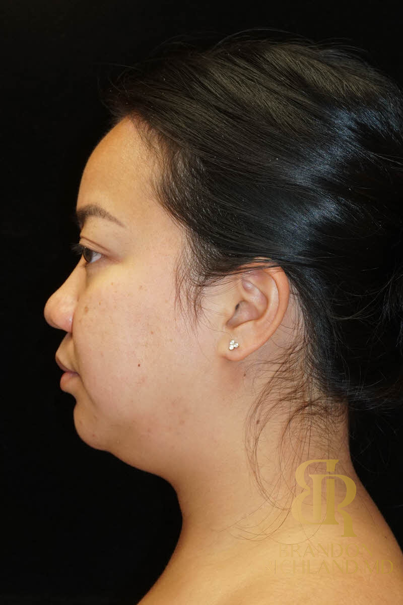 Renuvion Skin Tightening Before & After Image