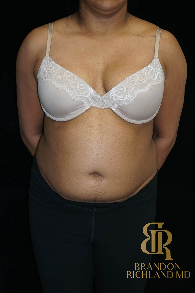 Renuvion Skin Tightening Before & After Image