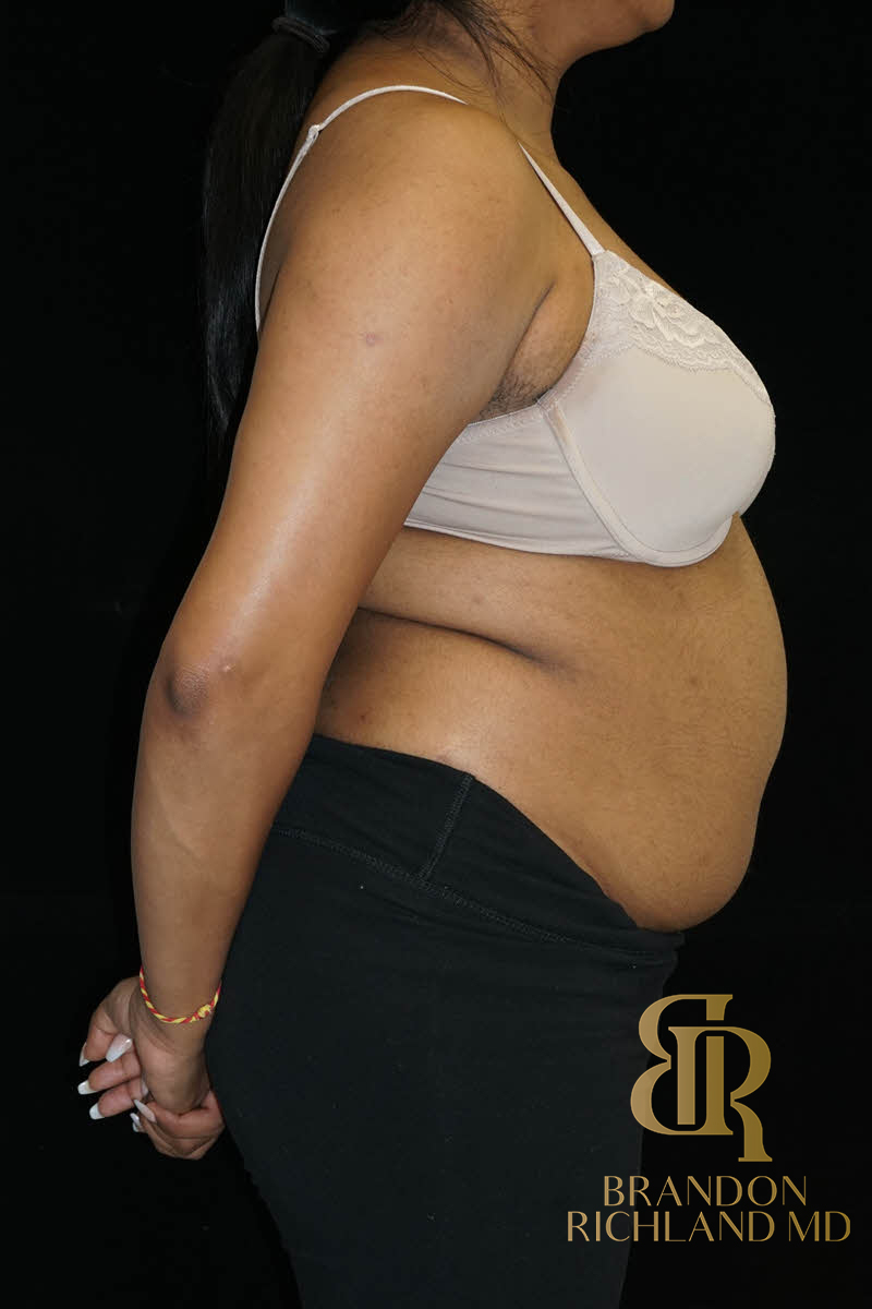 Renuvion Skin Tightening Before & After Image