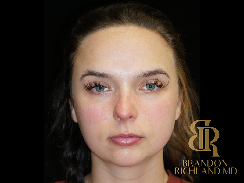 Renuvion Skin Tightening Before & After Image