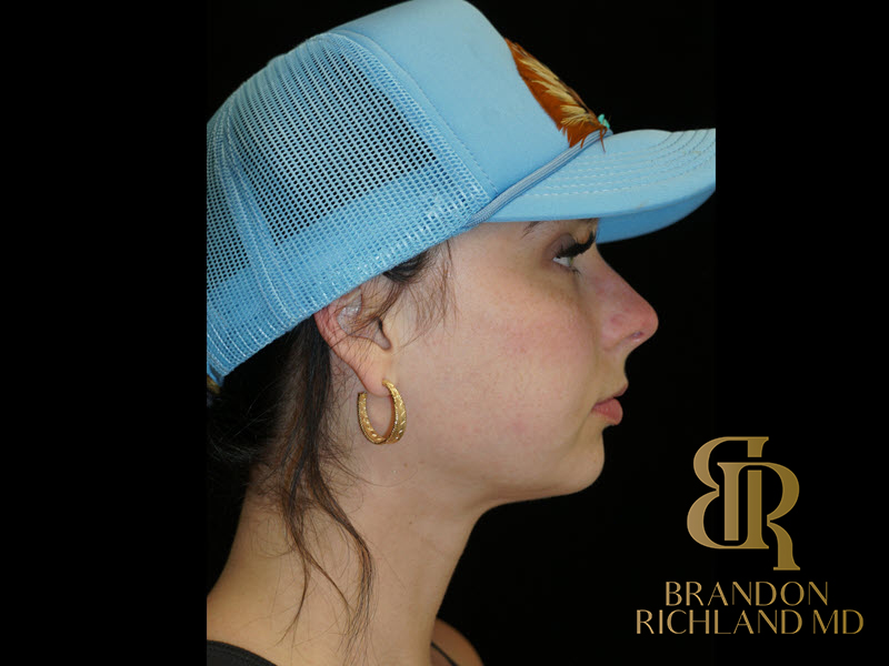 Renuvion Skin Tightening Before & After Image