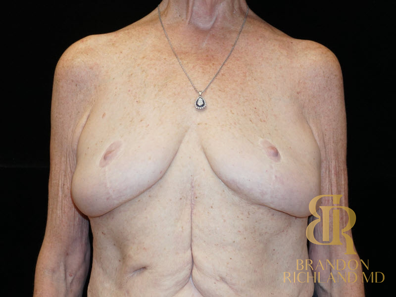 Breast Augmentation & Lift Before & After Image